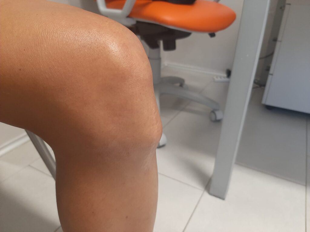 Morbo di Osgood Schlatter